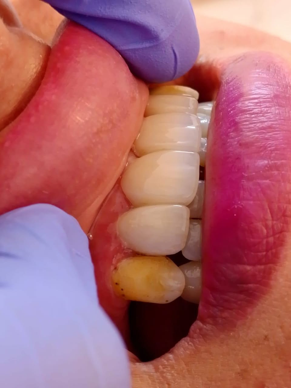 🌟 من اسنان متضرره إلى ابتسامة متكاملة
شغل تخليف وتلبيس بأفضل المواد وبأدق التفاصيل، حتى تكون النتيجة طبيعية ومريحة وتدوم لفترة طويلة.
رضاكم وثقتكم هي نجاحنا. 🦷🤍

الموقع/ حي 17 الشارع العام لمكتبة المهندس مجاور لمدرسة المشاعل

للحجز والاستفسار/ ***********

 متواجدين بلعيادة يومياَ  10صباحاَ لغاية 10مساءاَ

