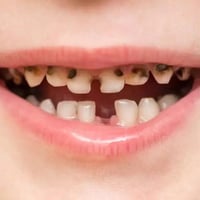 علاج اسنان • مجاني • اطفال ٥-١٥