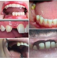 طقم متحرك • علاج مجاني • جامعة البيان