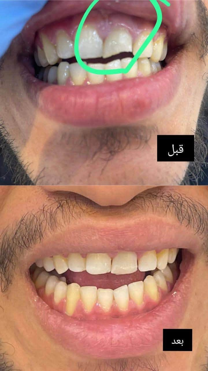 علاج أسنان مجاني • حشوات تجميلية • شارع فلسطين