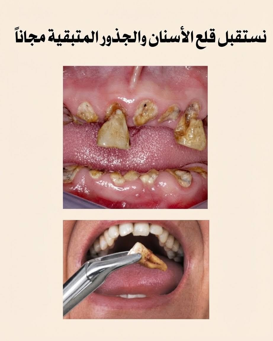 السلام عليكم
اني طالبة طب أسنان مرحلة رابعة
 
اشتغل عدة حالات مثل: 

• حشوات تجميلية 
• تنظيف أسنان وإزالة التكلسات والتصبغات
• قلع الأسنان والجذور المتبقية
• تعويض الأسنان بطقم جزئي متحرك

وأكيد العلاج مجاني وتحت إشراف أطباء أختصاص 

إذا عندك أي حالة من الحالات المذكورة بالبوست، صوّر الحالة ودز الصورة على الواتساب، حتى نقيم الحالة ونحدد موعد العيادة بإذن الله 🦷🥼

عنواني : جامعة الرافدين - بغداد - حي القاهرة - قرب الرعاية الأجتماعية 

رقم الواتساب: 
‎***********

نص مكتوب في الصور:
- رعاية كاملة لأسنانك جامعة الرافدين / بغداد / حي القاهرة دكتورة زهراء جاسم حشوات ضوئية "تجميلية" قلع الأسنان والجذور المتبقية تعويض الأسنان بطقم جزئي متحرك تنظيف الأسنان وإزالة التكلساك العلاج مجانا وتحت إشراف أطباء أختصاص للحجز وللاستفسار ارسل صورة للحالة على الواتساب *********** @dr.zahraa_j
- نستقبل حشوات ضوئية " تجميلية " مجاناً
- نستقبل تنظيف الأسنان وإزالة التكلسات والتصبغات مجاناً
- نستقبل قلع الأسنان والجذور المتبقية مجاناً
- تعويض الأسنان المفقودة بطقم جزئي متحرك مجاناً
- بعد
- قبل