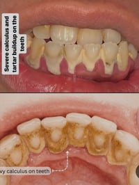 تنظيف اسنان • مجانا • تكلسات شديدة