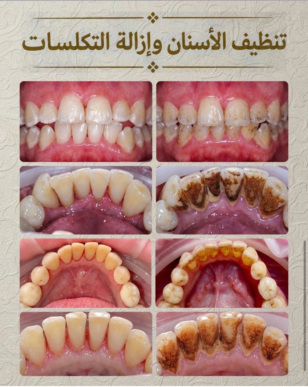 علاج مجاني • عيادات جامعة واسط • تنظيف وحشوات