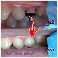 ترميم سن • تلبيس سن • ابومنيصير