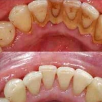 📍🦷📍 نعالج في عيادات جامعةالهادي   - قلع الاسنان والجذور التالفة - تنظي...