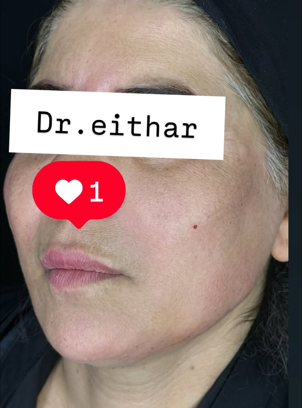 تجديد شد الوجه بالفلر  (لفتنك وجنات  واصداغ وتدوير الفك والذقن ونظاره وشفة سابقا حاقنتهه قبل سنه مجددناه لان متحتاج  ونظاره وبوتوكس  ) 🔥🔥🔥

اتمددت عروووض للكادر التدريسي والخريجات والموظفات والعروسات لنهايه الاسبوع ليوم الاربعاء اخر يوم  ثبتتهه الكم بالستوري بالهايلايت وببوست اعلى الصفحة ✨✨

د.ايثار سامي عبد الامير
واسط الكوت الهوره مجمع القبطان طابق اول 

الحجز***********

نص مكتوب في الصور:
- Dr.eithar
- 1
- Dr.eithar 1