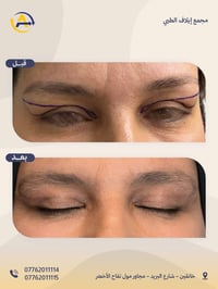 قص الأجفان • تجميل العيون • خانقين
