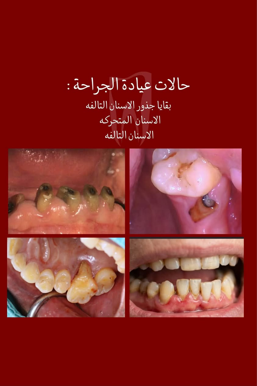 السلام عليكم
نعلن عن توفر خدمات العلاج المجاني للأسنان بشكل كامل 
تحت اشراف اطباء مختصيين 
بحالة عدكم 
(قلع ، تسوسات ، تعويض اسنان بطقم متحرك، تنظيف اسنان) والحالات الي موجوده بلصور وتحبون تعالجوها   بشكل مجاني تكدرون تتواصلون ويايه ونرتب موعد يناسبكم على الرقم  ***********  
موقع العيادات : الدوره _ شارع المصافي_ كلية دجله الجامعه

نص مكتوب في الصور:
- الدكتورة رغد عامر طالبة طب اسنان تحت التدريب من خدماتنا علاج تسوس الاسنان باستخدام الحشوات الضوئيه تعويضات صناعية للأسنان المفقوده تنظيف الاسنان وتلميع الاسنان من التكلسات قلع الاسنان وبقايا الجذورالتالفه احجز موعدك الأن الدورة_ شارع المصافي_ جامعة دجله *********** @msqai علماً ان العلاج مجاني و تحت اشراف اطباء مختصییبن
- حالات عيادة الجراحة : بقايا جذور الاسنان التالفه الاسنان المتحركه الاسنان التالفه
- حالات عيادة الحشوات :
- • تسوس على سطح السن
- • بين الاسنان الخلفيه
- • بين الاسنان الامامية
- • حافات الاسنان المكسوره
- • تسوس قريب اللته
- • ازالة الحشوات القديمة
- حالات عيادة التنظيف : التكلسات التصبغات بسبب التدخين والمشروبات اي احد يحب يسوي تنظيف يكدر يتواصل ويايه ( اللي موضح بلصوره كذلك )
- حالات عيادة التعويض : تعويض الاسنان المفقوده بطقم جزئي متحرك مثل الحالات الموضحه بلصور