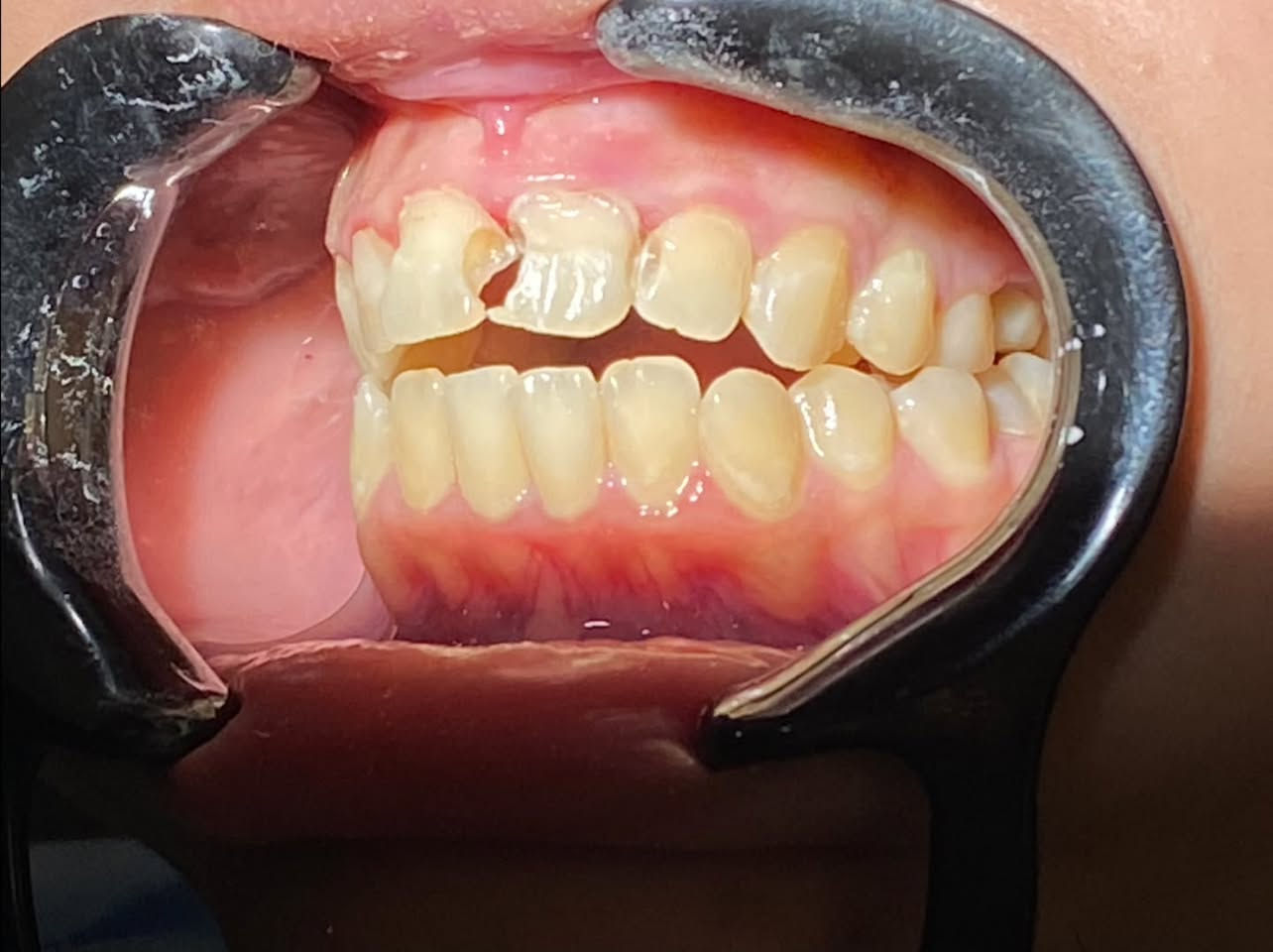 تبديل الحشوات القديمة وازالة التسوسات وتعويض بالحشوات التجميلية
