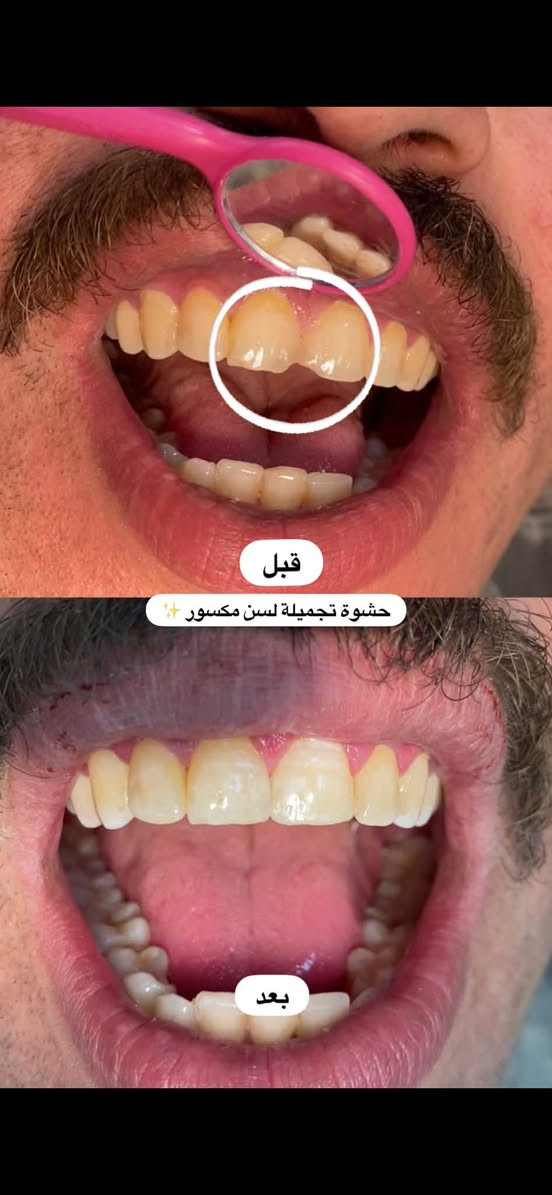 الدكتورة دانية الشمري
📍 كربلاء – عيادات جامعة الزهراوي
✨ العلاج مجاني ✨
الشغل موضح بالصور

📞 للحجز أو الاستفسار واتساب: ***********

عندك تصبغات أو تكلسات بالأسنان؟
احجز جلسة تنظيف حتى ترجع ابتسامتك المشرقة ✨

سن عقل ، سن مكسور، متآكل، أو باقي منه الجذر فقط؟
نقوم بقلع السن بكل راحة وأمان،
وبإشراف جرّاح اختصاص

تعاني من تسوّس؟
عالج السن قبل ما يوصل للجذر
 
اسنان اطفالك محتاجك علاج ؟
احجز موعدك اليوم وخلي ابتسامتك أجمل
