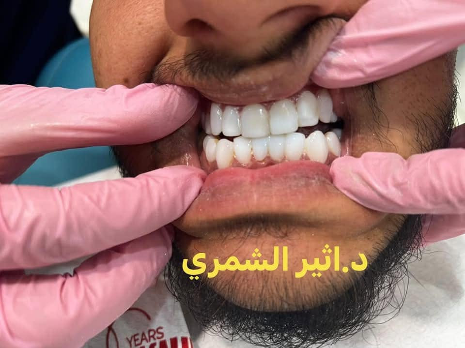 مستمرين ❤️‍🔥🥹
ابتسامه لاحد مراجعينا 🥰

ابتسامه المشاهير..اقرب منما تتوقع❤️‍🔥
مع الماستر فينير استمتع بابتسامه طبيعيه انيقه ومصممه لتناسب ملامحك🥰
هواي يتخوفون من تبيض وبرد الاسنان مالك حل غير دايركت فينير
✔️بدون برد
✔️بدون الم

احجز جلستك لدى عياده الدكتوره اثير الشمري
📍  العنوان: [حي العدل شارع الاسواق /مجاور لحوم رسول العنبر]
📞 للحجز والاستفسار: [***********]
📲 تواصلوا معنا عبر الواتساب: [***********]
جمالكِ يستحق الرعاية الأفضل.. بانتظار زيارتكِ!
#اكسبلور_explore #اكسسوارات #اكسبلور_فولو #اكسبلور_العراق_السعودية_الاردن_ايران_الكويت_طق_لايكات_كوم_نت_💚_فلولو_بغداد_ميوزكلي_العراق_لبنان_الامارات_البحرين

نص مكتوب في الصور:
- د.اثير الشمري