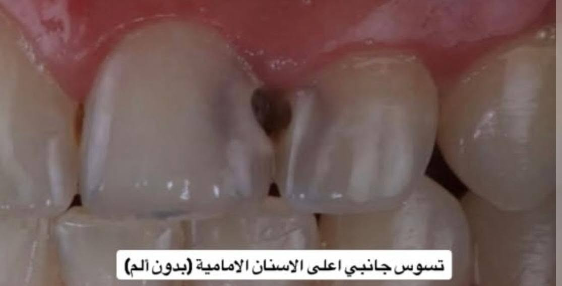 علاج مجاني • تنظيف اسنان • تسوس جانبي