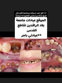 قلع مجاني • تحت إشراف أطباء • جامعة بلاد الرافدين