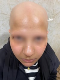 داء الثعلبة • قبل وبعد • د حاتم الهيتي