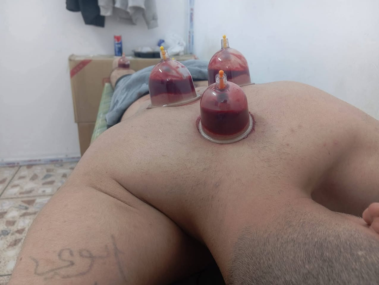 حجامة دموية • حجامة جافة • مساج