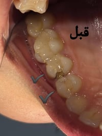 تغليف زاركون • ترميم سن • عيادة الاسكندريه