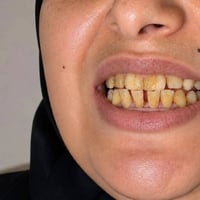 ابتسامتك تستحق تكون اجمل تخلصي من التصبغات واصفرار الاسنان وحصلي على ا...