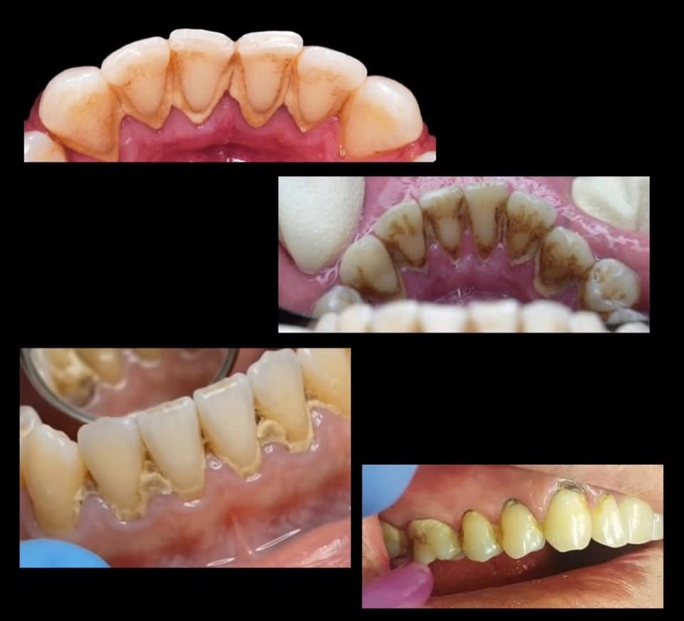 السلام عليكم
حالات مطلوبة للعلاج في جامعة المستقبل والعلاج مجاني 
1-حشوات لاغلب حالات التسوسات 
2-تنظيف اسنان من التكلسات والتصبغات 
3-قلع الجذور المتبقية والاسنان الهالكة غير قابلة للعلاج
4-تعويض الاسنان المفقودة بطقم جزئي متحرك
*علمًا العلاج يبدأ في بداية الاسبوع المقبل للحجز والاستفسار التواصل على
واتساب//***********
او انستا // zozo_zozoo17

نص مكتوب في الصور:
- 1-التسوس يكون بوسط السن. 2-تسوس بين الأسنان. (الأسنان الخلفية) 3-تسوس بين الأسنان. (الأسنان الأمامية) 4-تسوس او كسر للحافة القاطعة للأسنان الأمامية. 5-تسوس عند حافة اللثة.
- حالات القلع:
- تعويض الأسنان بطقم جزئي متحرك: