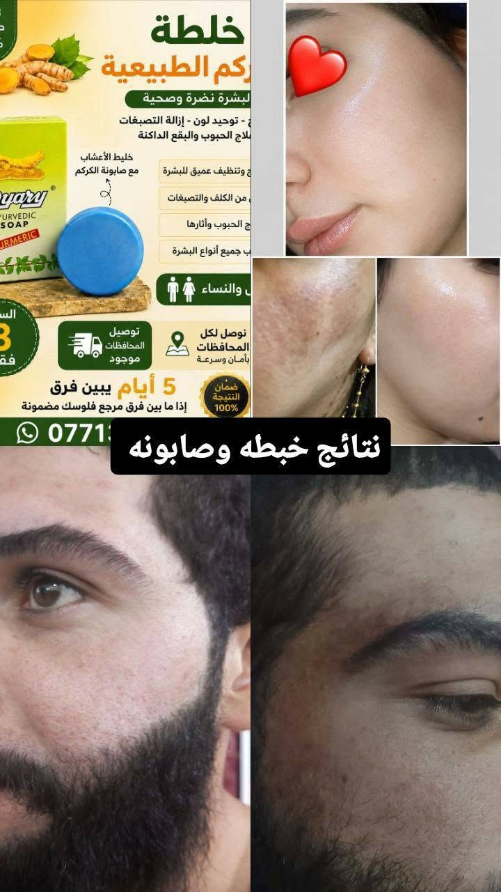 خلطة اعشاب طبيعيه للبشره مع صابونه الكركم 
تعالج كلف حبوب وإثارة تصبغات 

خلال 5ايام يبين فرق إذا مابين فرق مرجع فلوسك مضمونه 

تواصل وتساب ***********
