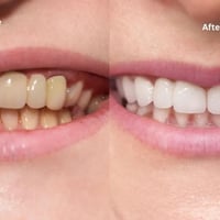 تنظيف اسنان • تبييض اسنان • جامعة الاسراء