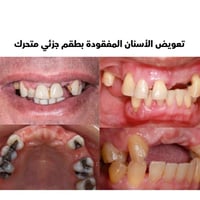 علاج مجاني • قلع الأسنان • طقم متحرك