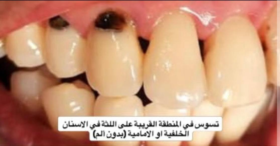 علاج مجاني • تنظيف اسنان • تسوس جانبي