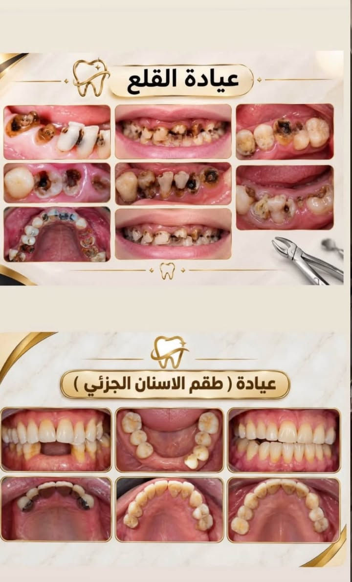 علاج مجاني • قلع أسنان • عيادة الفراهيدي