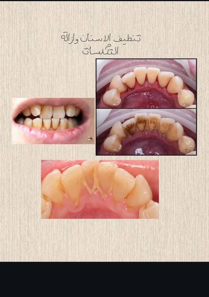 علاج مجاني • قلع الأسنان • علاج أسنان الأطفال