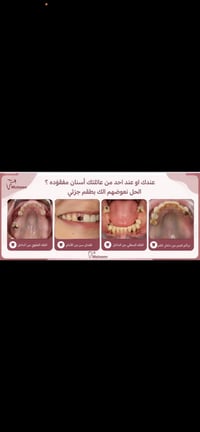 طقم جزئي • اسنان مفقودة • موعد باجر