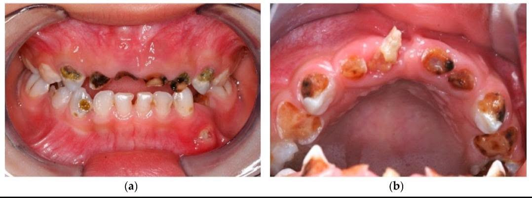 مجانا • طقم أسنان كامل • عيادات جامعة الحلة