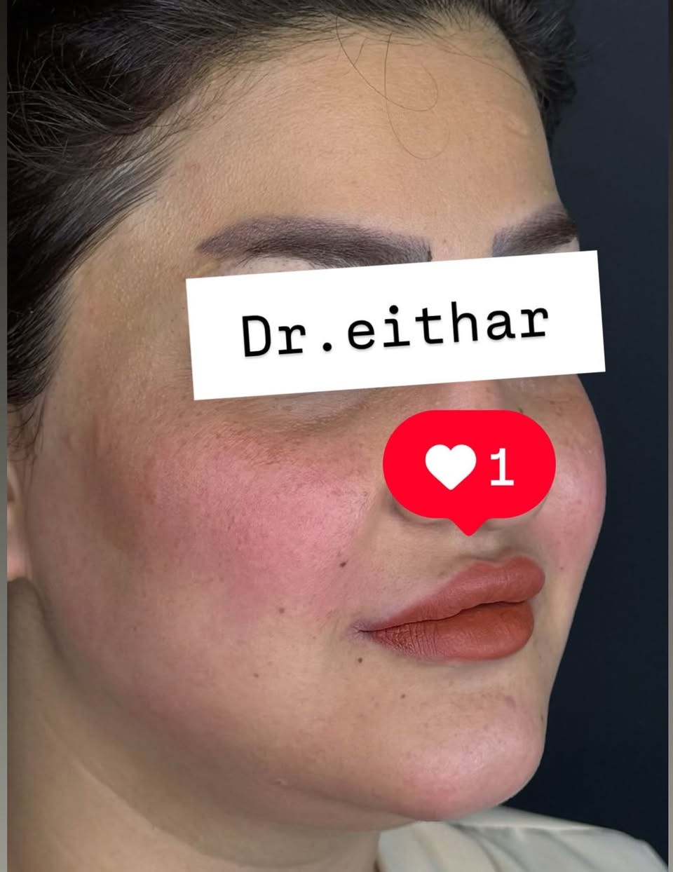 كونتور الوجه بالفلر  (لفتنك وجنات  واصداغ وتدوير الفك والذقن ونظاره وشفة قبل ٣ سنين حاقنتهه الهه مجددناه  ) 🔥🔥
لاحضو الفرق بالذقن ومنطقه الفك والوجنات شكد تغير الشكل🔥
عروووض للكادر التدريسي والخريجات والموظفات والعروسات  ثبتتهه الكم بالستوري بالهايلايت وببوست اعلى الصفحة ✨✨

د.ايثار سامي عبد الامير
واسط الكوت الهوره مجمع القبطان طابق اول 

الحجز***********
