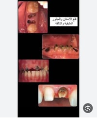الي محتاج قلع يراسلني خاص الموقع :عيادات جامعه الهادي بغداد الدوره نها...