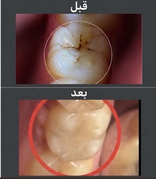 قلع جذور • عيادات الجامعة • كلية الرافدين