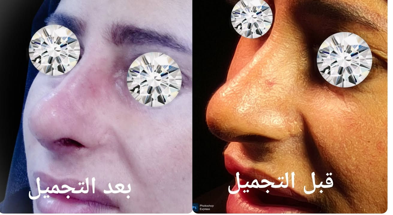 ترميم الأنف • تجميل أنف ثانوي • عيادة الياسيري