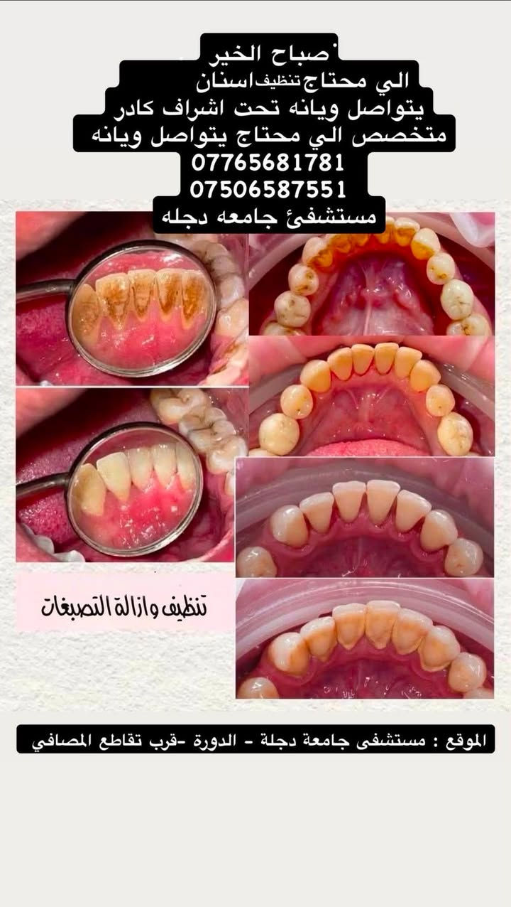 🦷 عندك مشكلة بأسنانك وتحتاج علاج؟

نستقبل حاليًا حالات علاج الأسنان مجانًا، وتشمل:

▫️ الحشوات الضوئية
▫️ قلع الأسنان وبقايا الجذور
▫️ تنظيف الأسنان وإزالة الجير والتصبغات
▫️ تعويض الأسنان المفقودة

👩🏻‍⚕️ يتم تقييم الحالة قبل العلاج، والعمل تحت إشراف أطباء اختصاص.

📍 بغداد، الدورة، شارع المصافي، عيادات كلية دجلة

📩 للحجز والاستفسار: ***********

***********

إذا تعرف شخص يحتاج علاج، شاركه المنشور 🤍🦷

نص مكتوب في الصور:
- DUCOD College Of Dentistry 2004 د. عبدالله فارس ستار كلية طب الأسنان - جامعة دجلة العلاج مجاني بإشراف أطباء اختصاص الخدمات المتوفرة تنظيف وتلميع الاسنان حشوات ضوئية طقم جزئي متحرك قلع الجذور المتبقية و الاسنان التواصل *********** *********** @dr_abdullah_fares @1_ym0 *********** كلية طب الاسنان - جامعة دجلة - الدورة - قرب تقاطع المصافي
- صباح الخير الي محتاج علاج التسوس و حشوة تجميلية يتواصل ويانه تحت اشراف كادر متخصص الي محتاج يتواصل ويانه *********** *********** مستشفي جامعه دجله علاج تسوس الاسنان بحشوات تجميلة الموقع: مستشفى جامعة دجلة - الدورة - قرب تقاطع المصافي
- صباح الخير الي محتاج تنظيف اسنان يتواصل ويانه تحت اشراف كادر متخصص الي محتاج يتواصل ويانه *********** *********** مستشفى جامعه دجله تنظيف وازالة التصبغات الموقع : مستشفى جامعة دجلة - الدورة -قرب تقاطع المصافي
- صباح الخير الي محتاج قلع اسنان اماميه يتواصل ويانه تحت اشراف كادر متخصص الي محتاج يتواصل ويانه *********** *********** مستشفى جامعه دجله الموقع :مستشفى جامعة دجلة - قرب تقاطع المصافي
- اهلا من الاسبوع الجاي راح نبدي نشتغل بعياداتنا تحت اشراف اطباء وكادر طبي متخصص
- لهذه الحالات الي راح اذكرها الي سالوني راسلوني احجز لكم موعد
- قلع الاسنان والجذور المتبقية:
- تعويض الاسنان المفقودة بطقم متحرك:
- الحشوات الضوئية وتكون بلون السن الاصلي:
- Before
- After
- تنظيف الاسنان وازلة البقع والتكلسات: