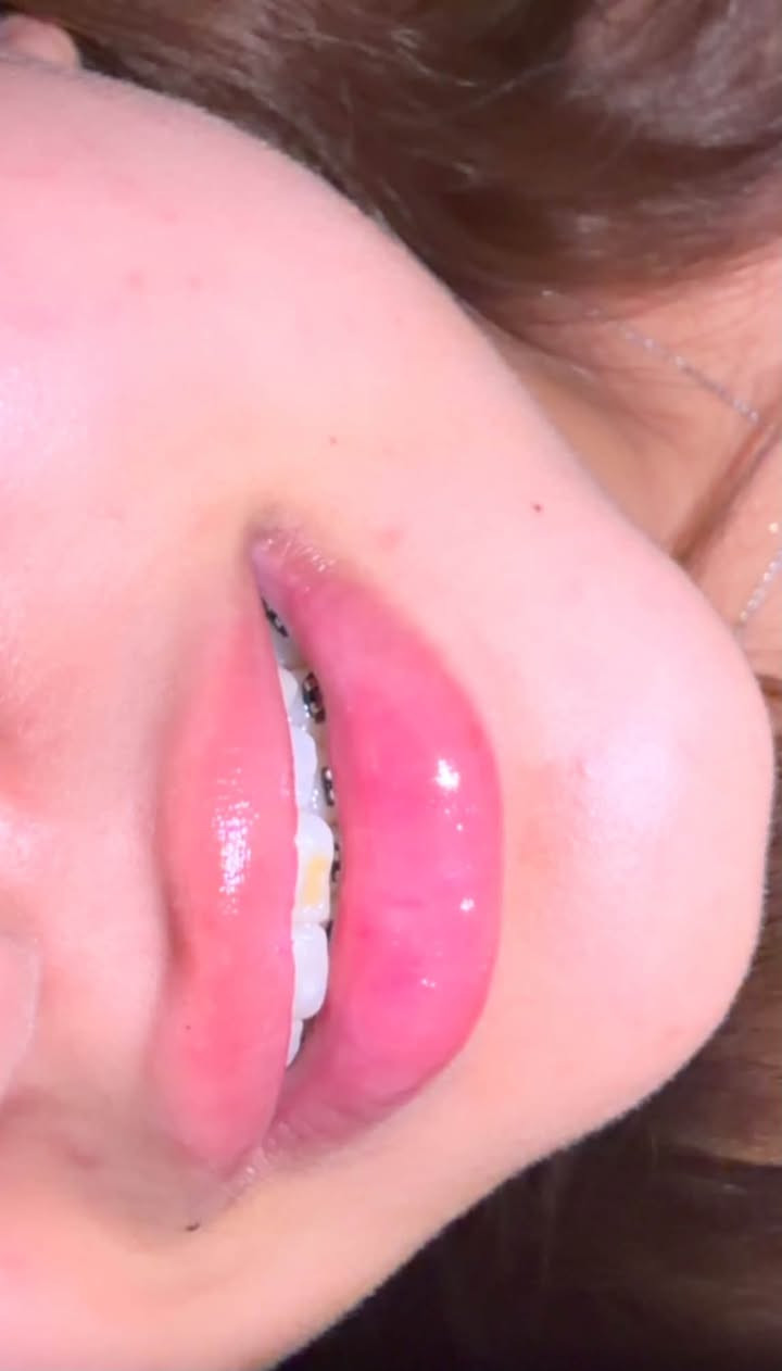 � شفايف أكثر امتلاءً… بتناسق طبيعي وأنيق ✨

فلر الشفاه في Evora Clinic
لإبراز جمال الشفاه وتحديد الكونتور بطريقة ناعمة ومدروسة 🤍

✨ زيادة الامتلاء بشكل متناسق
✨ تحديد وتنسيق شكل الشفاه
✨ تحسين التناسق بين الشفة العلوية والسفلية
✨ إطلالة ناعمة وطبيعية بدون مبالغة

لأن الجمال مو بالامتلاء فقط…
الجمال بالتناسق ✨

📍 حي الجامعة – قرب صيدلية السوسن
📞 ***********

Evora Clinic | عيادة إيفورا
جلدية • تجميل غير جراحي • ليزر@إشارة
