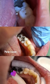 عيادة رينيو تقدملكم افضل الحشوات العلاجية والتجميلية والتبييض بالليزر ...