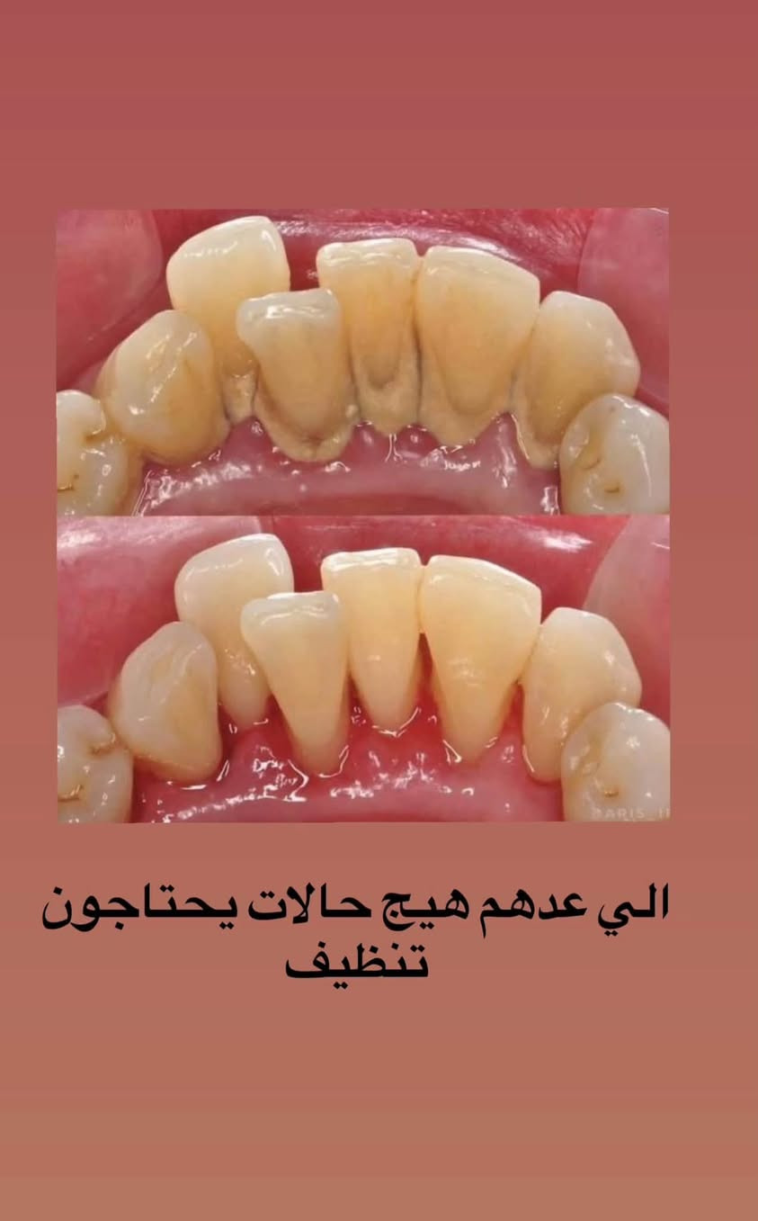 � رجعت العيادات، وراح أرجع أستلم حجوزات!
إذا عندك/ج سن مأجل علاجه من زمان.. يمكن هسه وقته! 🦷🤍

🚨 جبتلكم خبر حلو هم!
صرت أستلم أطفال وأعتني بأسنانهم 👧🏻🧒🏻🦷
إذا يحتاجون علاج للتسوس، ونقدر نسويلهم تطبيق فلورايد لحماية أسنانهم ✨

وكذلك أستلم حشوات جذور للأسنان الأمامية 🦷

📍 العنوان: جامعة التراث – المنصور
☎️:***********
Inst:dr__.manar

الحالات تشمل:
🦷 الحشوات
🦷 حشوات الجذور
🦷 القلع
🦷 تنظيف الأسنان
🦷 تركيب طقم كامل للأسنان المفقودة

🤍 علماً أن العلاج مجاناً وتحت إشراف الأطباء الاختصاص.

وسيتم تنزيل الحالات المطلوبة، فإذا حابين تكون حالتكم من ضمن الحالات، راسلوني حتى يتم تثبيت الموعد 🌷

وأتشرف جداً أكون أنا اللي أتابع حالاتكم 🤍🫶�

نص مكتوب في الصور:
- الي عدهم هيج جذور متبقية راسلوني
- الي عدهم هيج حالات يحتاجون تنظيف
- و الي هيج شمنتظرين ؟ تعالوا تنظيف مجاني FREE
- مثل هيج حالات من الاسنان الاماميه تكون مكسورة او متآكله همين نرجع الابتسامه الحلوه الكم
- لو هيج حالات من التسوس يكون قريب من اللثه