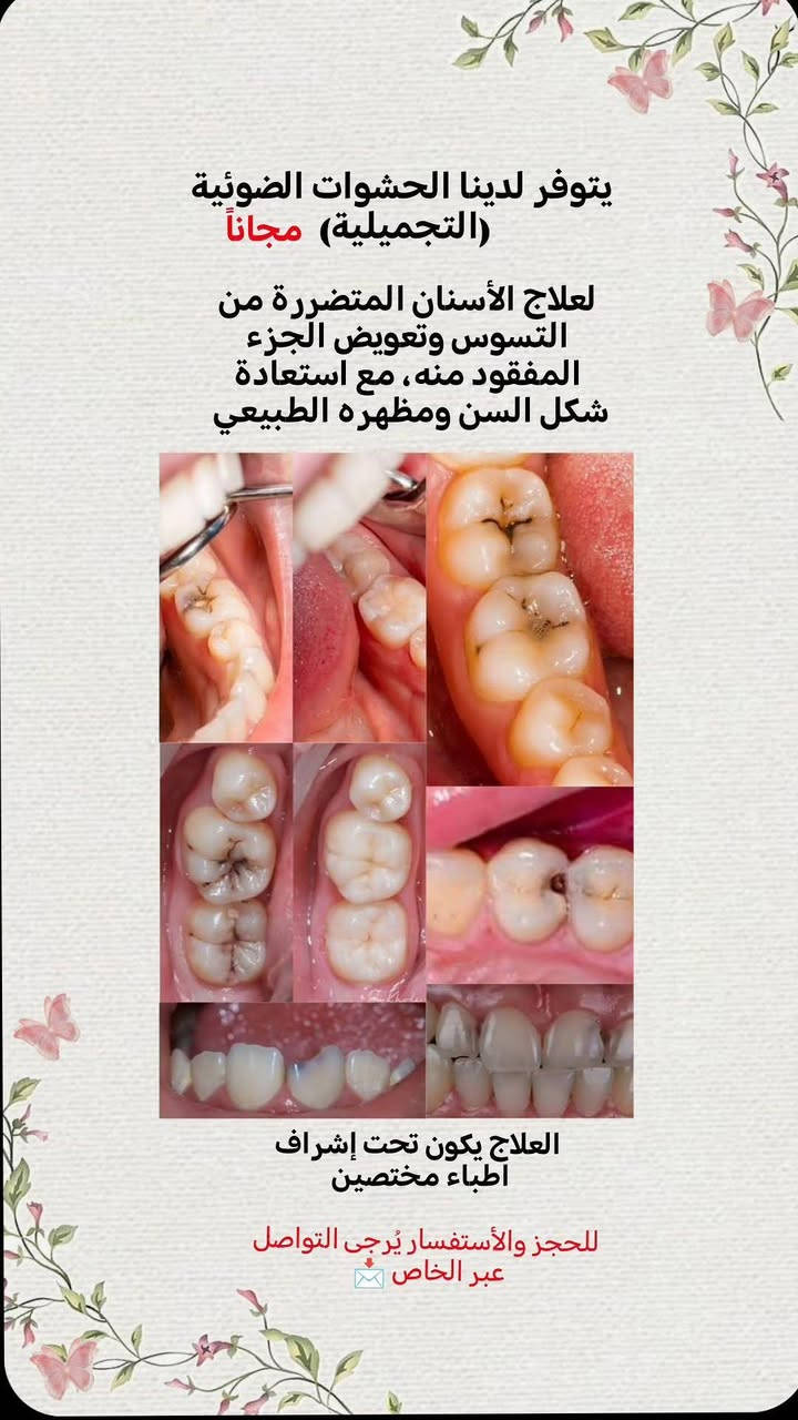 حشوات ضوئية • تنظيف أسنان • بغداد الدورة