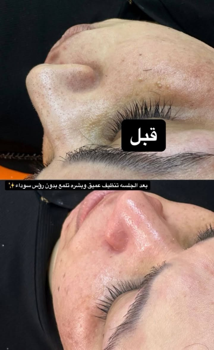 ✨ نضارة بشرتك بتبدأ من التنظيف العميق! ✨
بشرتك بتستحق عناية حقيقية مو بس شكلية. التنظيف العميق مو رفاهية، هو أساس لأي روتين عناية ناجح 
جلسة تنظيف البشره
✔️ تتخلصي من الأوساخ والرواسب
✔️ تحصلي على ترطيب عميق
✔️ تفتحي المسام وتخلي البشرة تتنفس
✔️ تسترجعي إشراقة ونضارة طبيعية

دلّلي نفسج بجلسة تنظيف بشرة مميزة، لأن بشرتك مرآتك.p

نص مكتوب في الصور:
- نظافه البشره يمي غير ✨🔥
- قبل
- بعد الجلسه تنظيف عميق وبشره تلمع بدون رؤس سوداء ✨
- لوله
- بيوتي لوله
- تجديد خلايه بشره نظيفه بدون رؤس وتلمع من النظافه 🔥 ✨