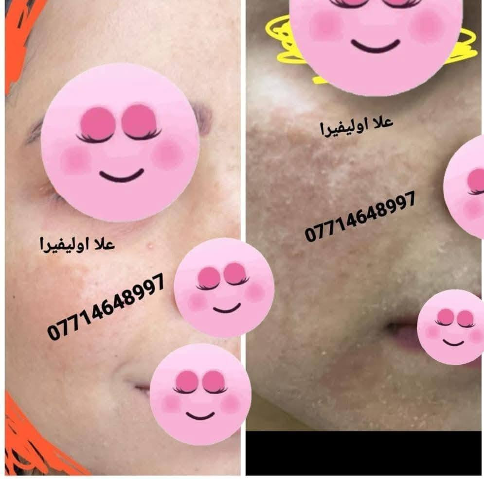 هايرونك • باكشويل • فرع ميسان
