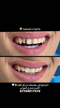 لا توجد تفاصيل  نص مكتوب في الصور: - حشوات تجميليه 😍 المراجع قرر يضحك ...