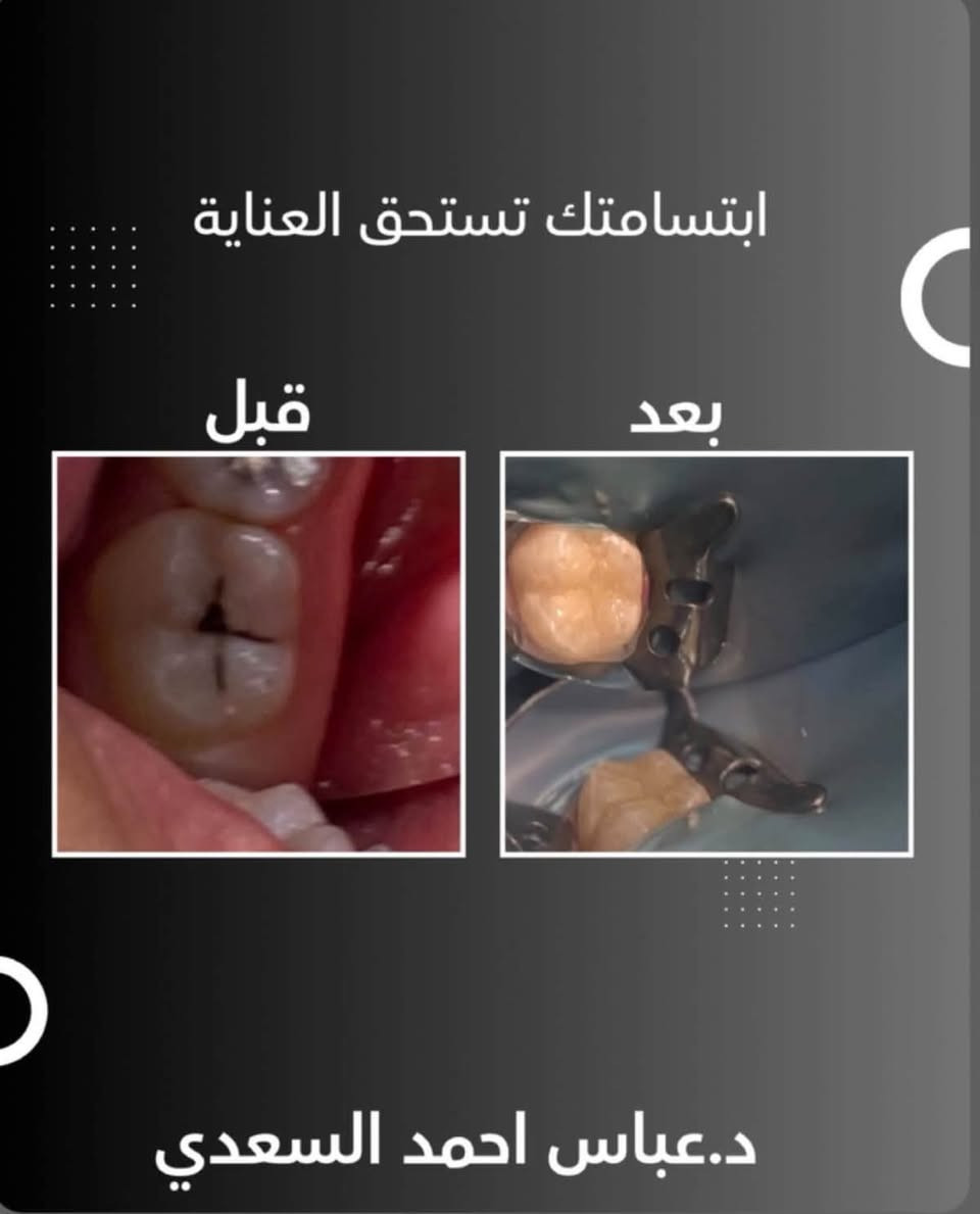 � هل تعاني من ألم بالأسنان أو تحتاج إلى علاج؟
إذا عندك مشكلة بأسنانك، لا تأجلها لحد ما تكبر المشكلة.

🔹 علاج وقلع الأسنان
🔹 الحشوات والعلاجات التجميلية
🔹 علاج وخدمات أسنان الأطفال 🧒🏻
🔹 الأطقم المتحركة الكاملة 🦷
🔹 فحص وتشخيص الحالات

العلاج مجاني ‼️

👨🏻‍⚕️ تحت إشراف أطباء أسنان مختصين

📍 عيادات جامعة الهادي – الدورة – نهاية شارع 60

📩 للحجز والاستفسار راسلوني خاص او الاتصال على الرقم 📞 ***********

الدكتور عباس أحمد السعدي 🦷

نص مكتوب في الصور:
- ابتسامتك تستحق العناية قبل بعد الدكتور.عباس احمد السعدي
- Before After د. عباس أحمد السعدي أخصائي طب الأسنان
- نتائج شغلنا بتتكلم!
- قبل
- بعد
- الدكتور . عباس احمد السعدي
- ابتسامتك تستحق العناية
- د.عباس احمد السعدي