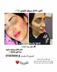 بعياده #تــდــــوته_كراند ✨ #التغيير_الشامل للحصول على بشره #جميله… لأ...
