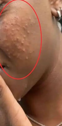 علاج حب الشباب • عشبي طبيعي • أبو نور العطار