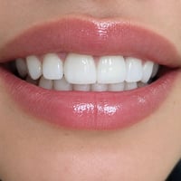 تركيب أسنان • أسنان أمامية • عيادة لانا