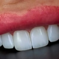 ابتسامة دائمة • بدون برد • تجميل أسنان