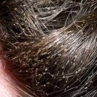 حجامة • أعشاب • علاج قمل