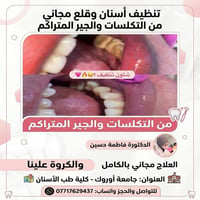 تنظيف أسنان • قلع مجاني • جامعة أوروك