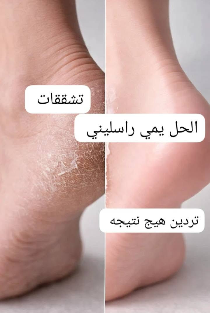 السلام عليكم توفرت خلطه قدم تزيل فطور تورد تنعم سعر علبه 3 آلاف ثنين بخمسه متوفر توصيل *********** للحجز مراسله الرقم واتساب. الخلطه كلش زينه تنعيم توريد تزيل الفطور والخشونه
